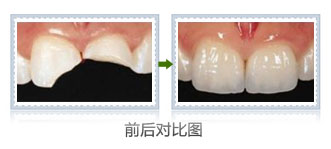 郑州小孩补牙多少钱