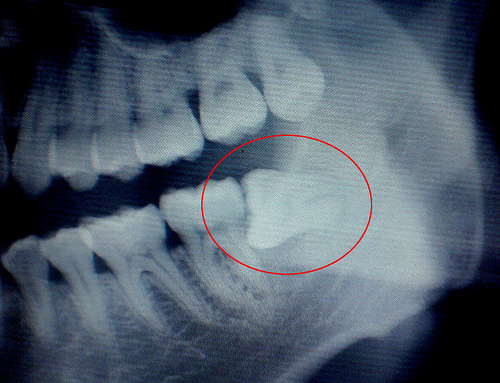 智齿发炎一定要拔吗