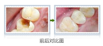 补牙材料价格表