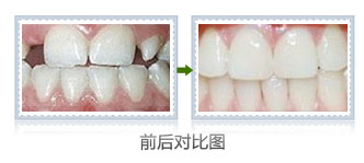 纳米树脂补牙多少钱一颗