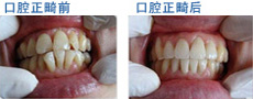 24岁想矫正牙齿用什么方法